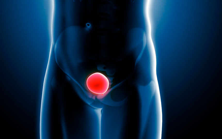 Câncer Na Bexiga: Nova Terapia Para Tratamento Do Carcinoma Urotelial é Aprovada Pela Anvisa