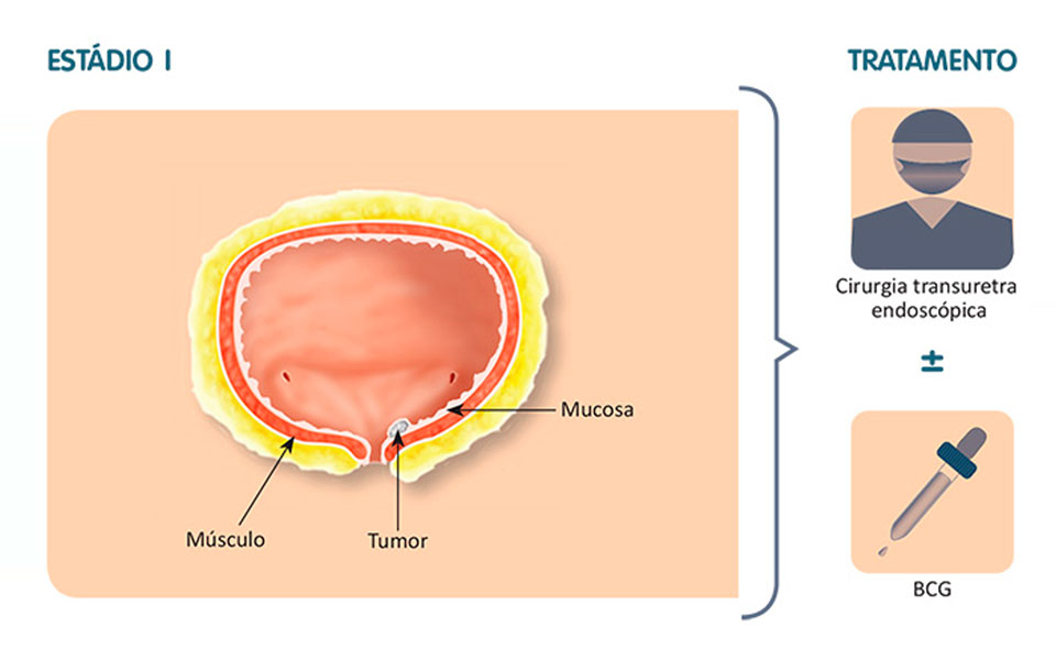 Tratamento Intravesicais