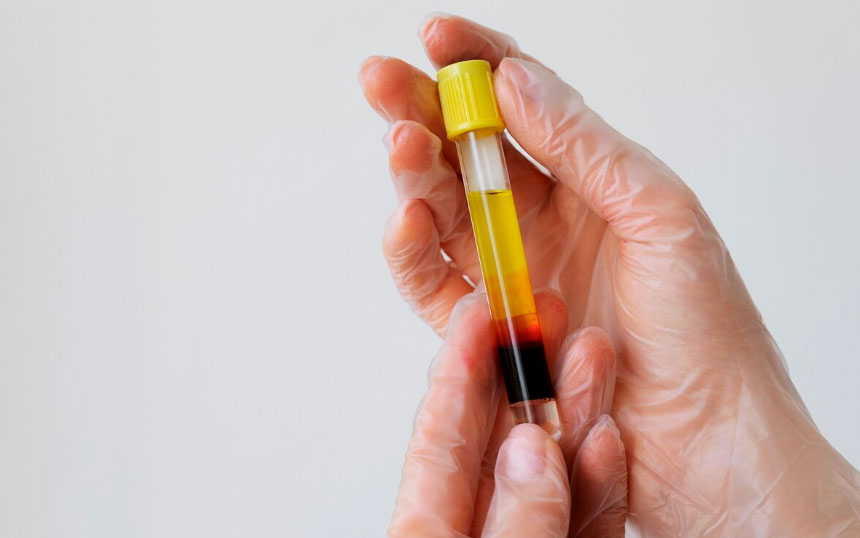 Detecção de marcadores tumorais - câncer urológico